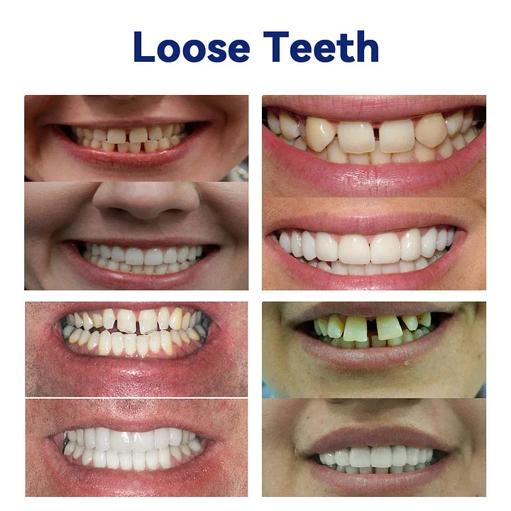 TREVONX™ - 🦷Avancerat Anpassat Fullständigt Tandprotes-set🦷 (⏰Tidsbegränsad rabatt ⏰)