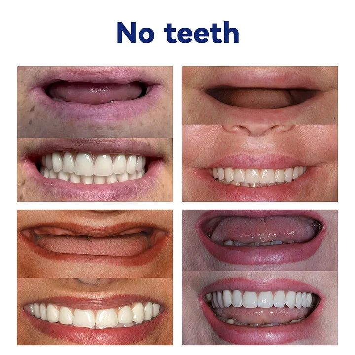 TREVONX™ - 🦷Avancerat Anpassat Fullständigt Tandprotes-set🦷 (⏰Tidsbegränsad rabatt ⏰)